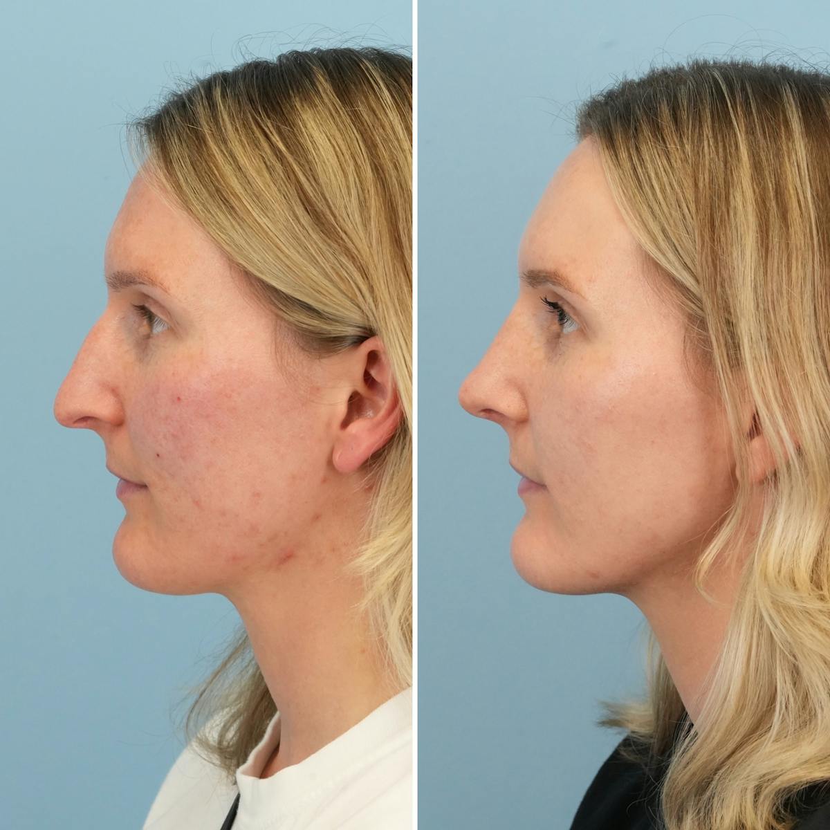 Rhinoplasty Before & After Gallery - Patient 279738 - Image 9