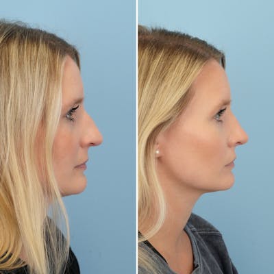 Rhinoplasty Before & After Gallery - Patient 581719 - Image 1