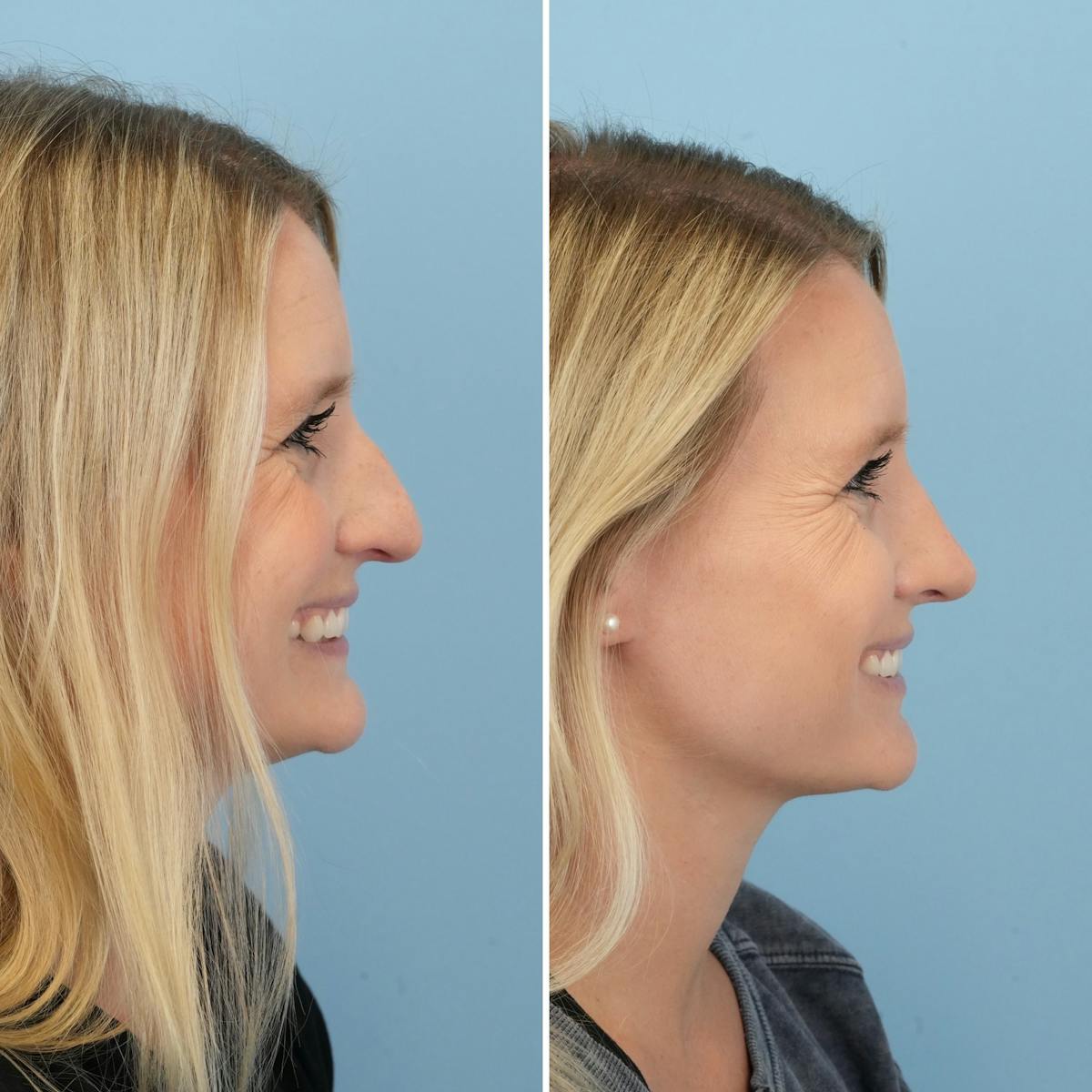 Rhinoplasty Before & After Gallery - Patient 581719 - Image 2