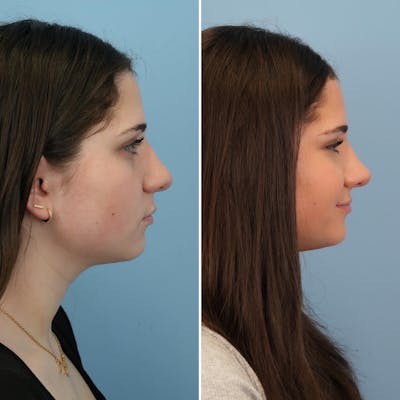 Rhinoplasty Before & After Gallery - Patient 333135 - Image 1