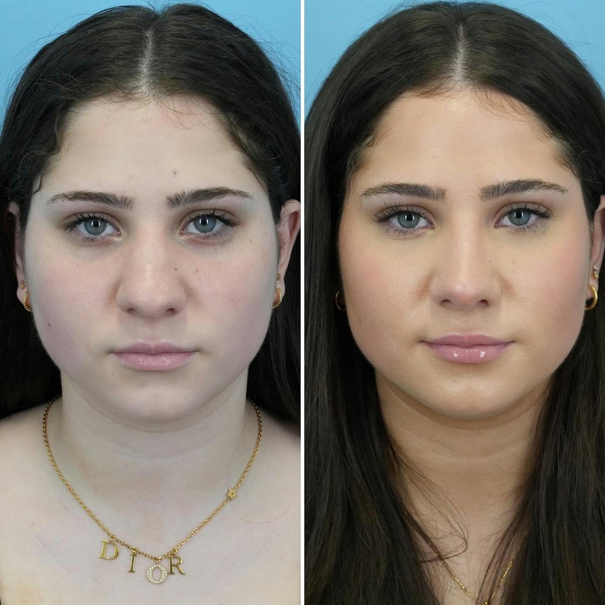 Rhinoplasty Before & After Gallery - Patient 612516 - Image 3