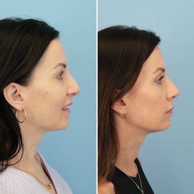 Rhinoplasty Before & After Gallery - Patient 275586 - Image 1