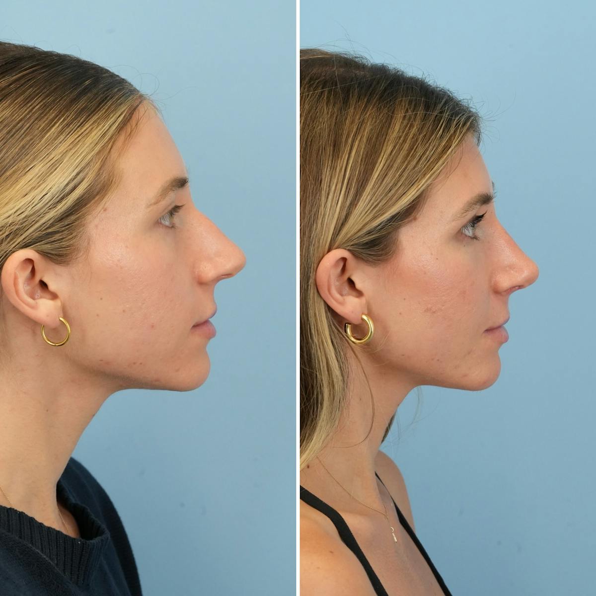 Rhinoplasty Before & After Gallery - Patient 226682 - Image 1