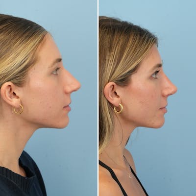 Rhinoplasty Before & After Gallery - Patient 226682 - Image 1
