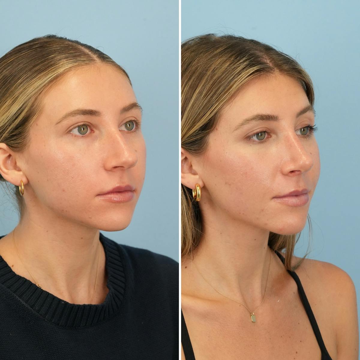 Rhinoplasty Before & After Gallery - Patient 226682 - Image 3
