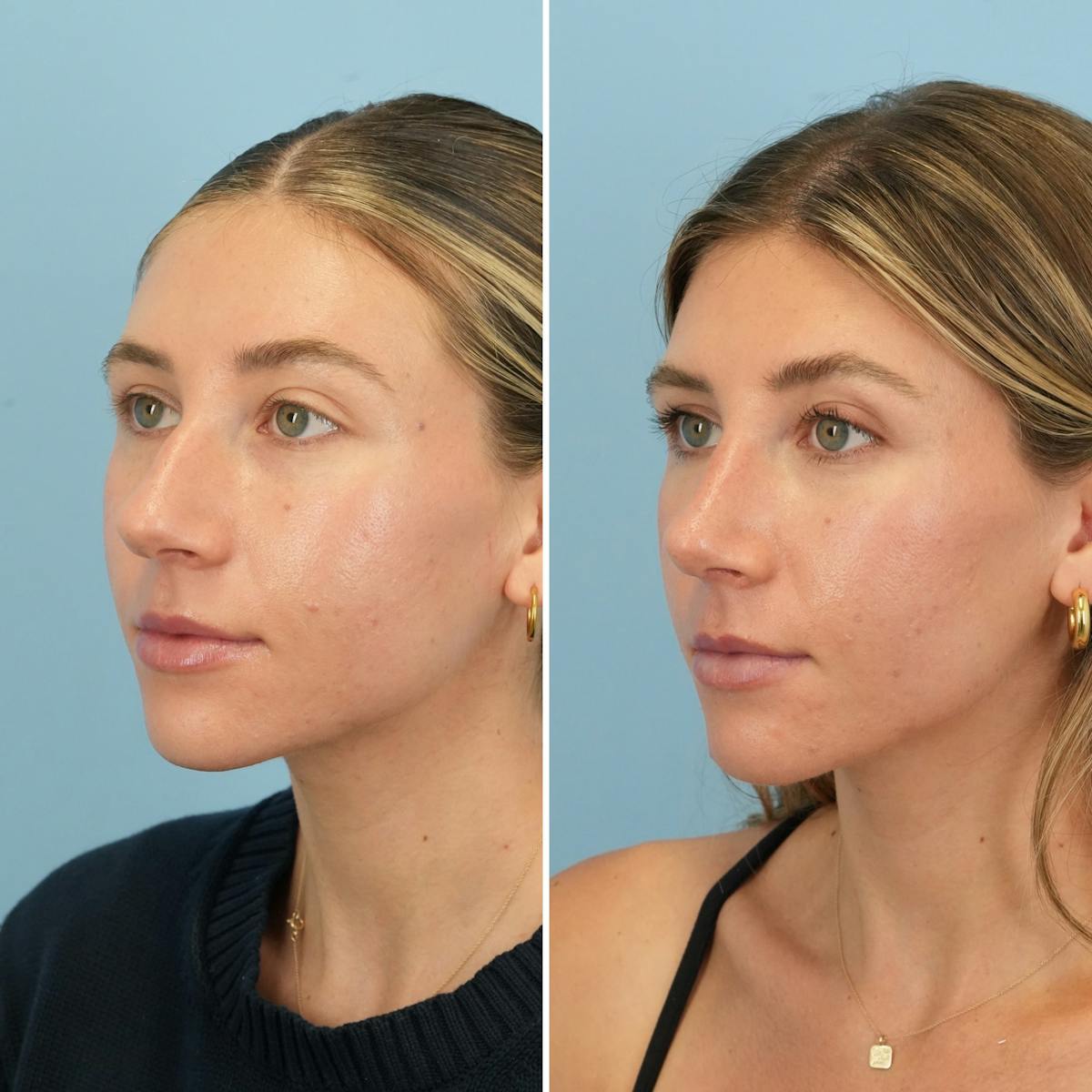 Rhinoplasty Before & After Gallery - Patient 226682 - Image 6