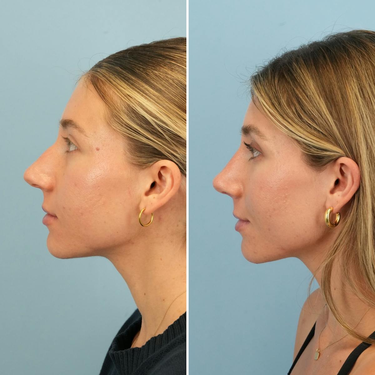 Rhinoplasty Before & After Gallery - Patient 226682 - Image 9