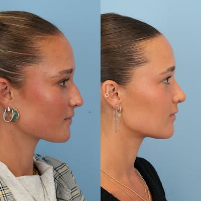 Rhinoplasty Before & After Gallery - Patient 295887 - Image 1