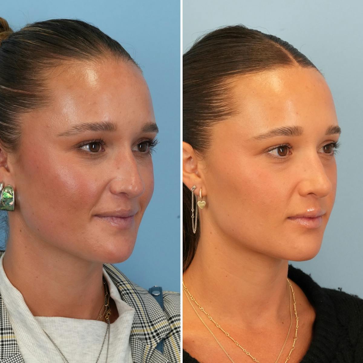 Rhinoplasty Before & After Gallery - Patient 295887 - Image 3