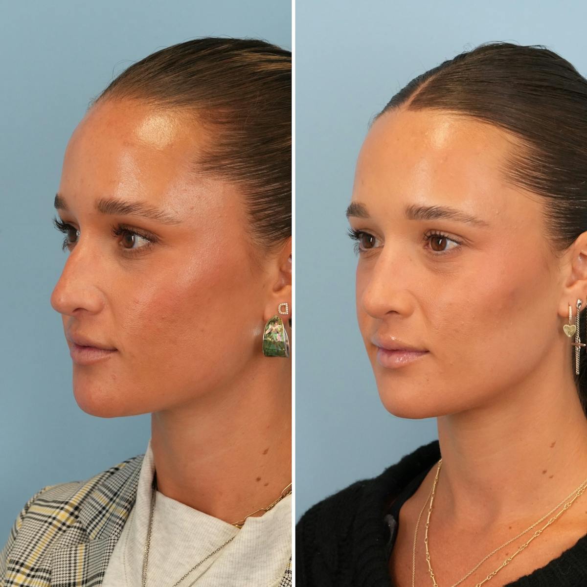 Rhinoplasty Before & After Gallery - Patient 295887 - Image 4