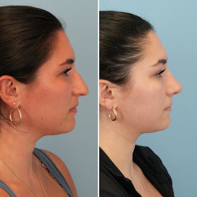 Rhinoplasty Before & After Gallery - Patient 167470 - Image 1