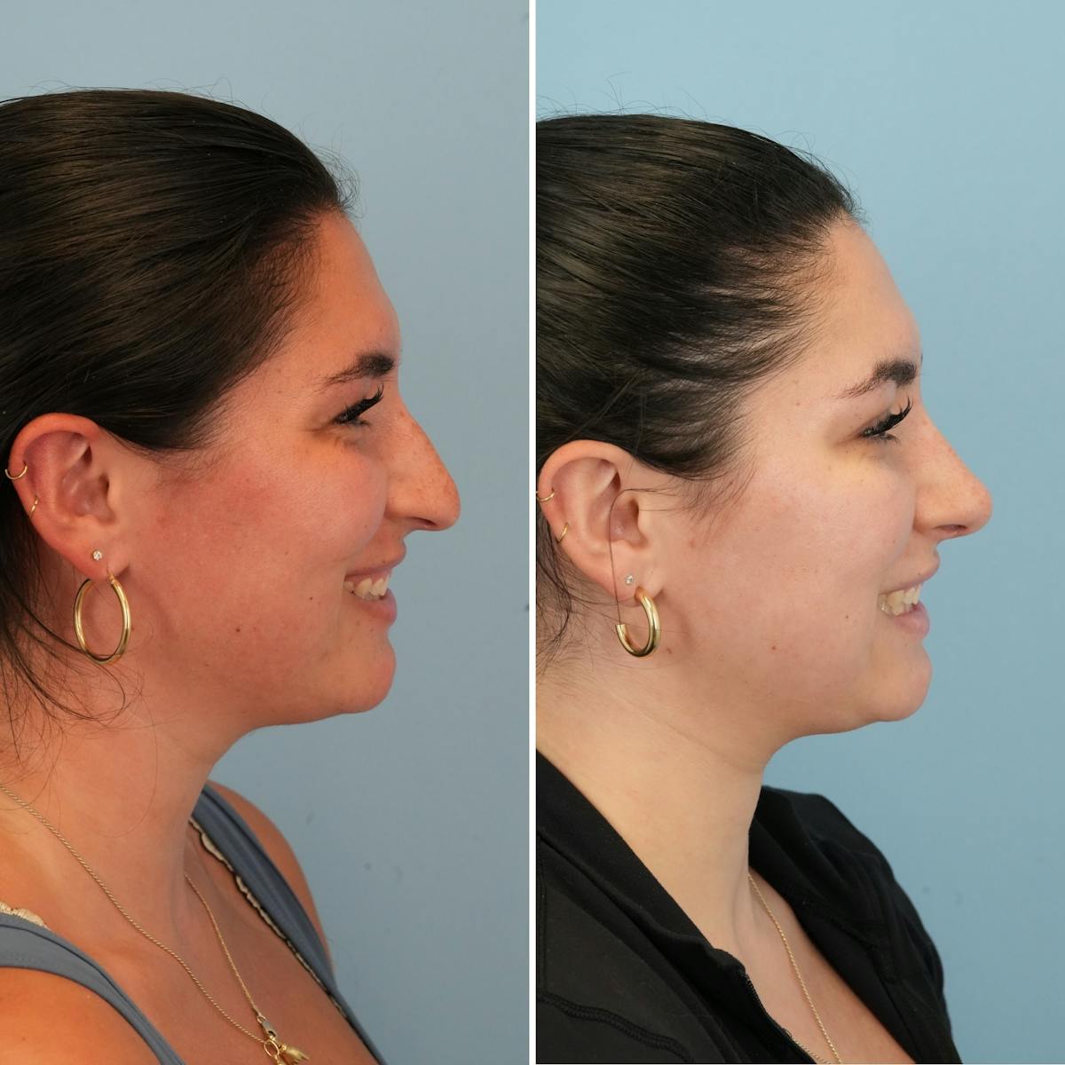 Rhinoplasty Before & After Gallery - Patient 167470 - Image 2