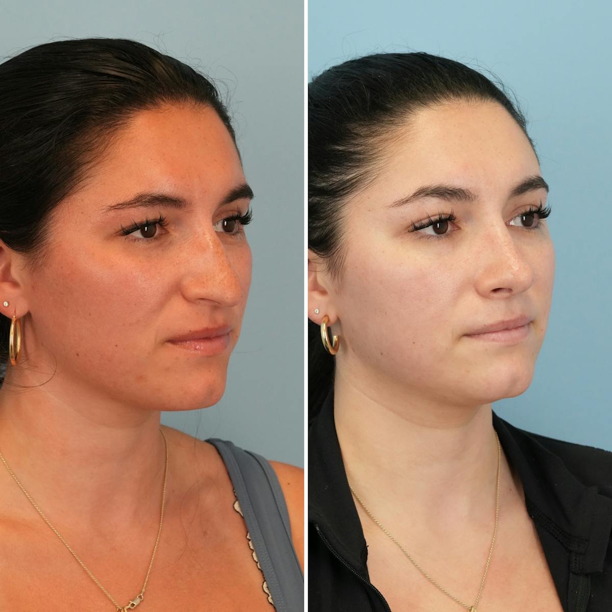 Rhinoplasty Before & After Gallery - Patient 167470 - Image 3