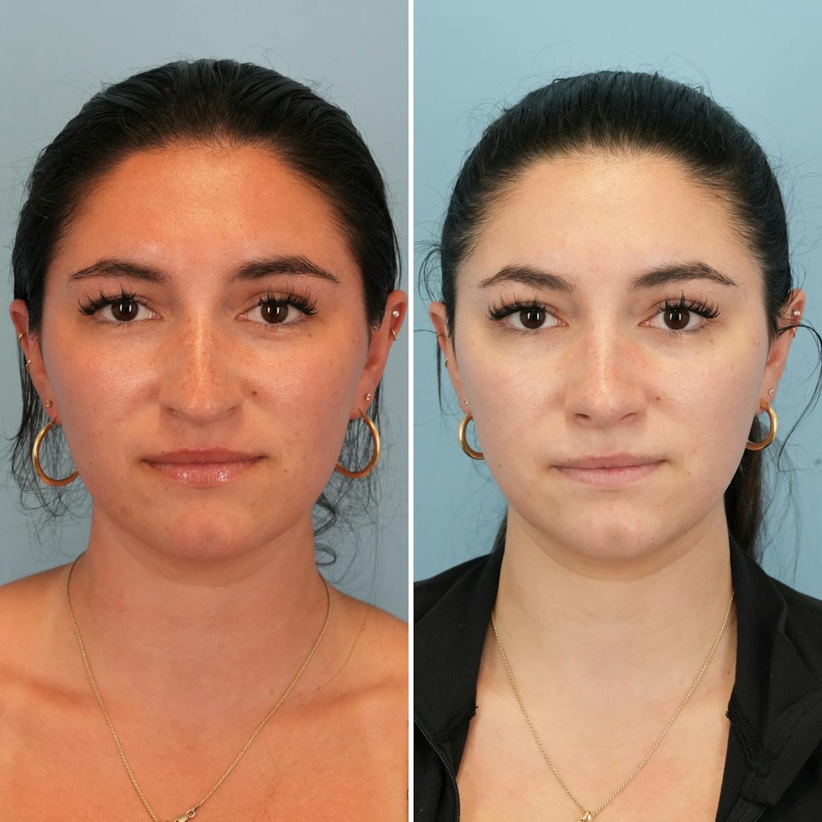 Rhinoplasty Before & After Gallery - Patient 167470 - Image 4
