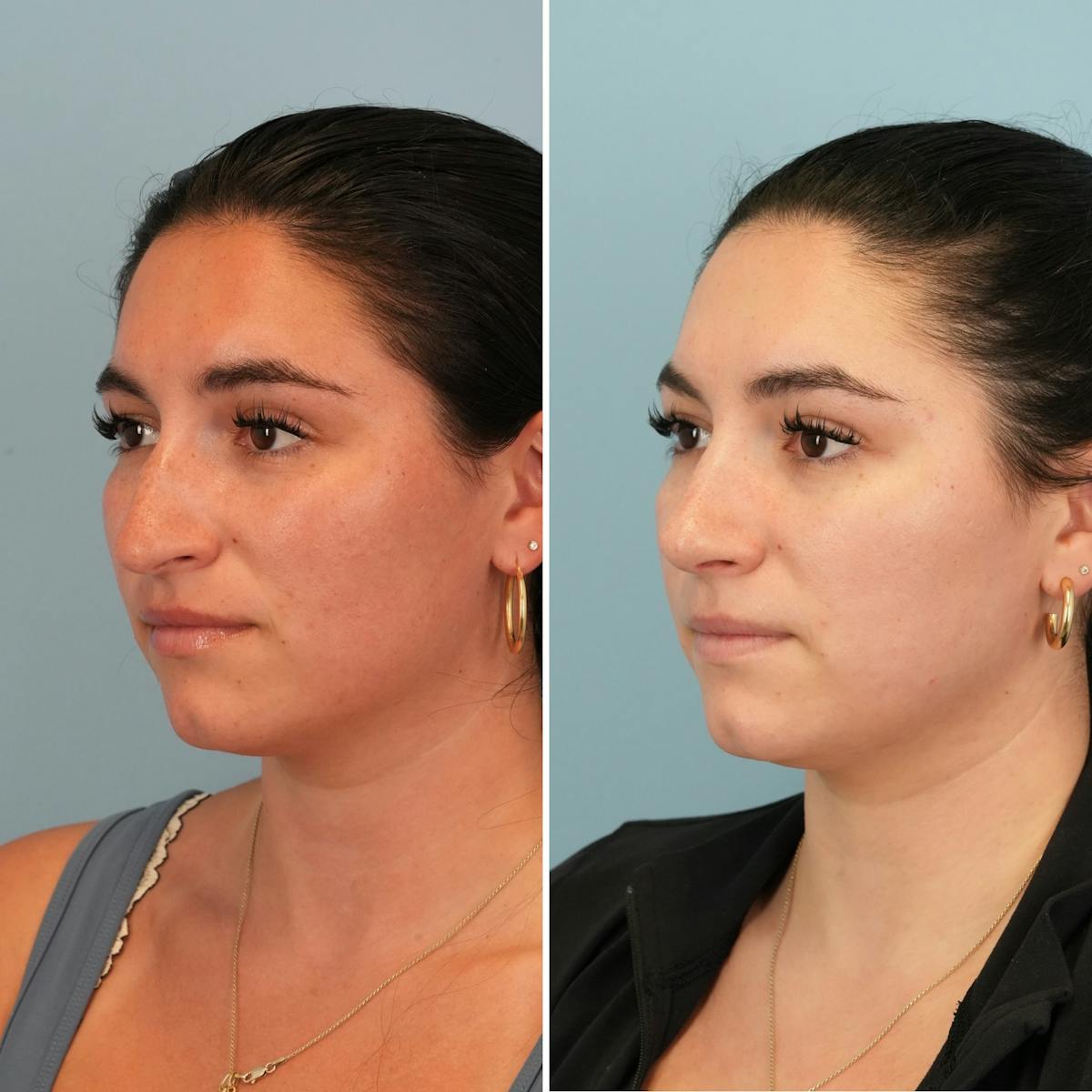 Rhinoplasty Before & After Gallery - Patient 167470 - Image 5