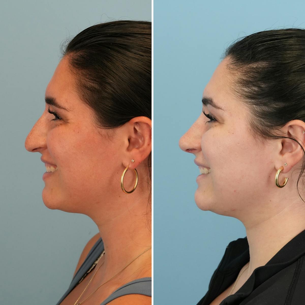 Rhinoplasty Before & After Gallery - Patient 167470 - Image 6