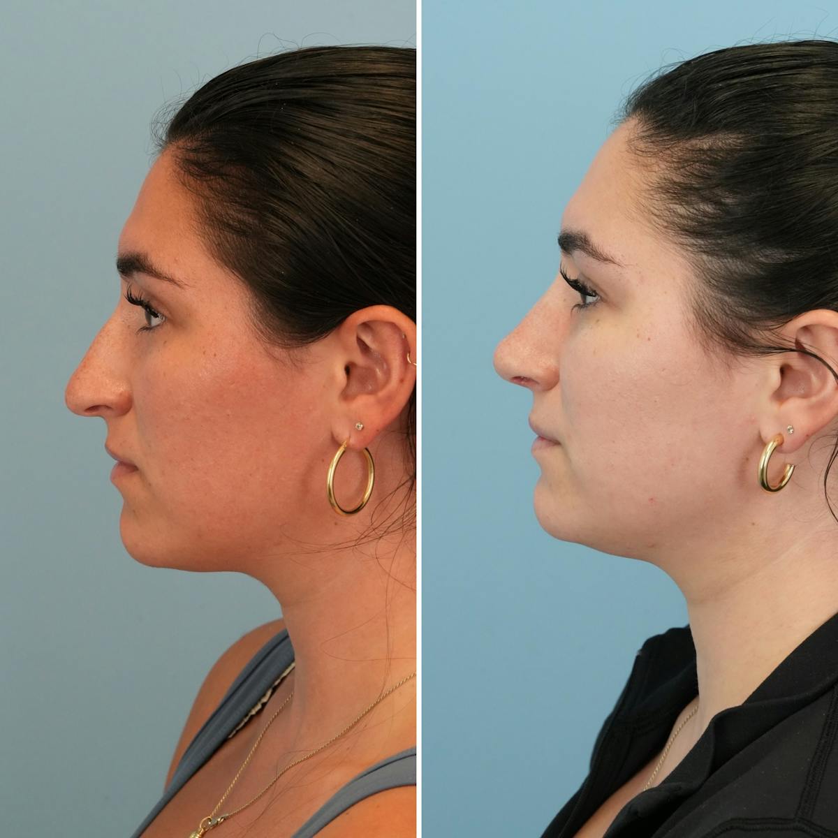 Rhinoplasty Before & After Gallery - Patient 167470 - Image 7