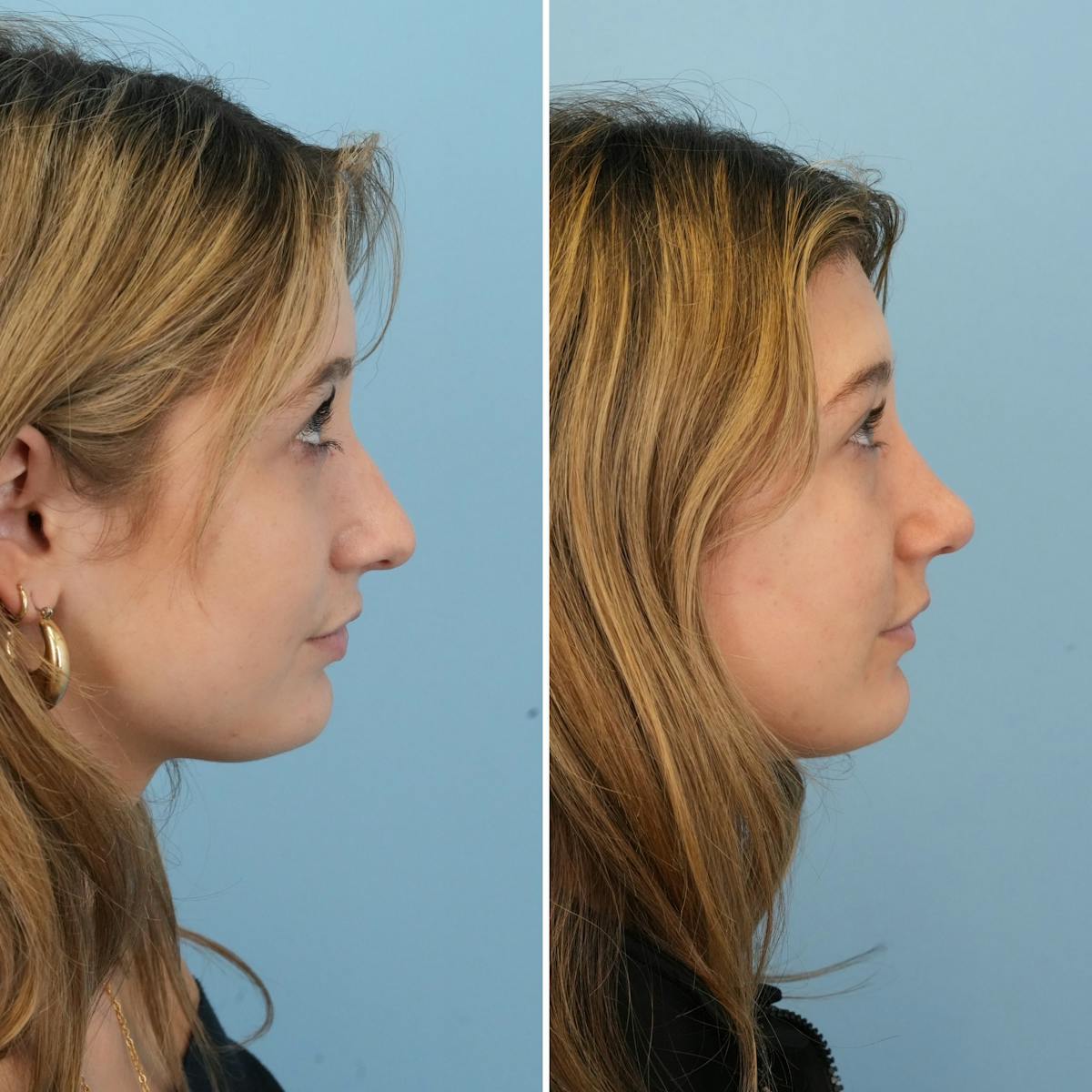 Rhinoplasty Before & After Gallery - Patient 177155 - Image 1