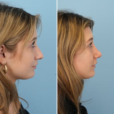 Rhinoplasty Before & After Gallery - Patient 177155 - Image 1