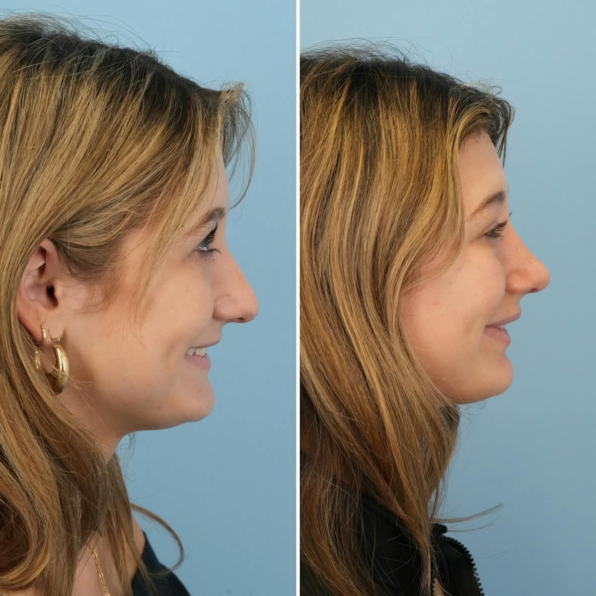 Rhinoplasty Before & After Gallery - Patient 177155 - Image 2