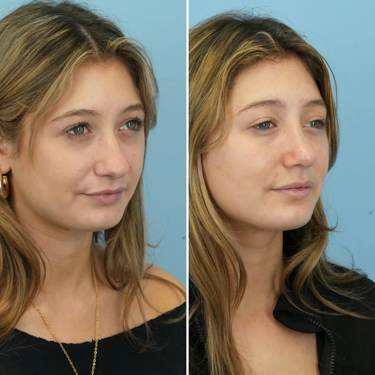Rhinoplasty Before & After Gallery - Patient 177155 - Image 3