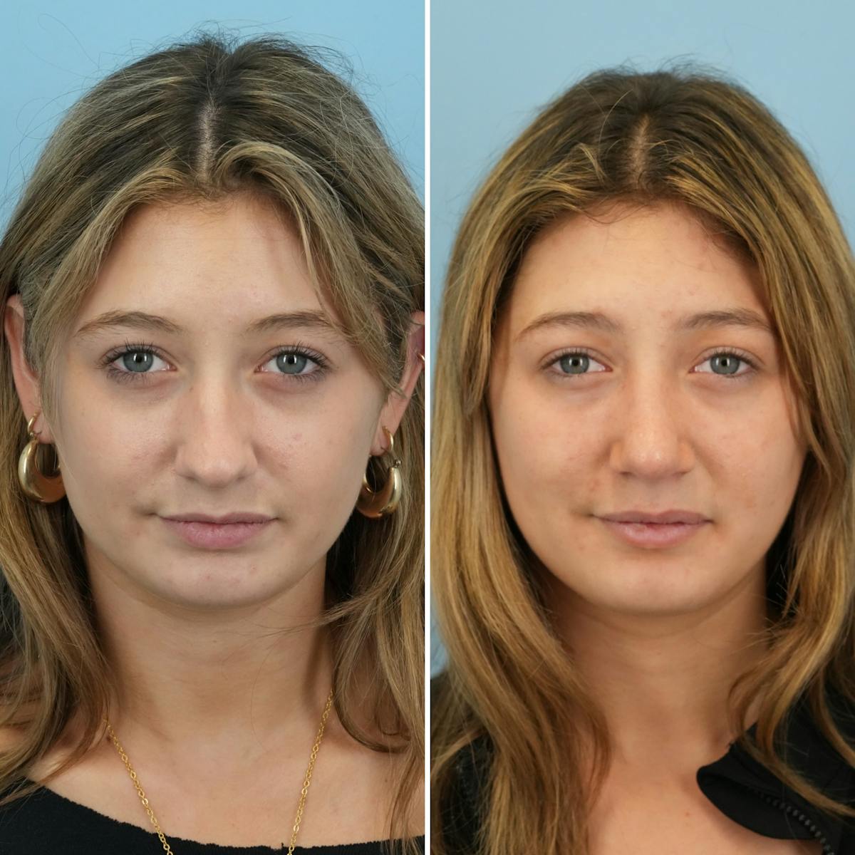 Rhinoplasty Before & After Gallery - Patient 177155 - Image 4