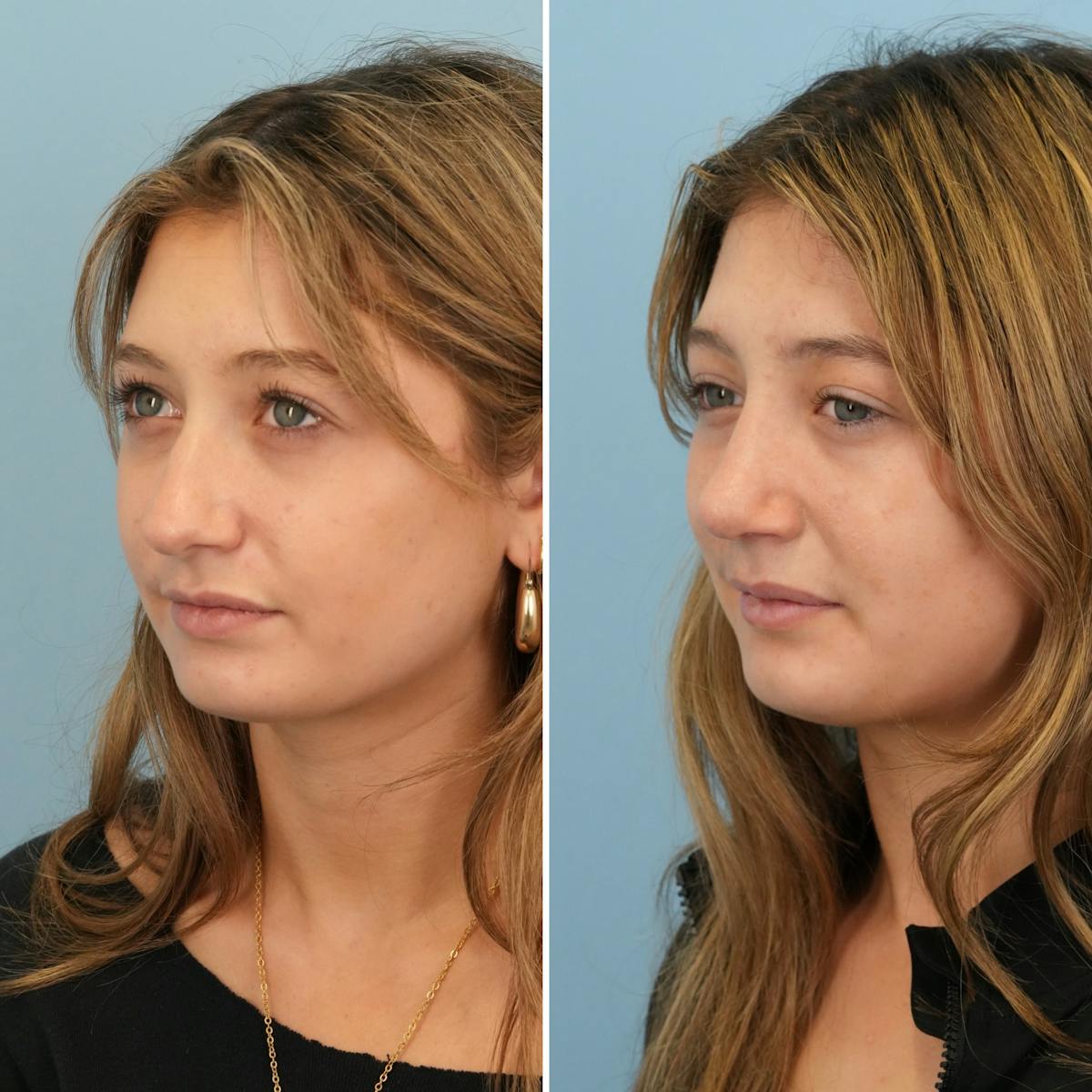 Rhinoplasty Before & After Gallery - Patient 177155 - Image 5