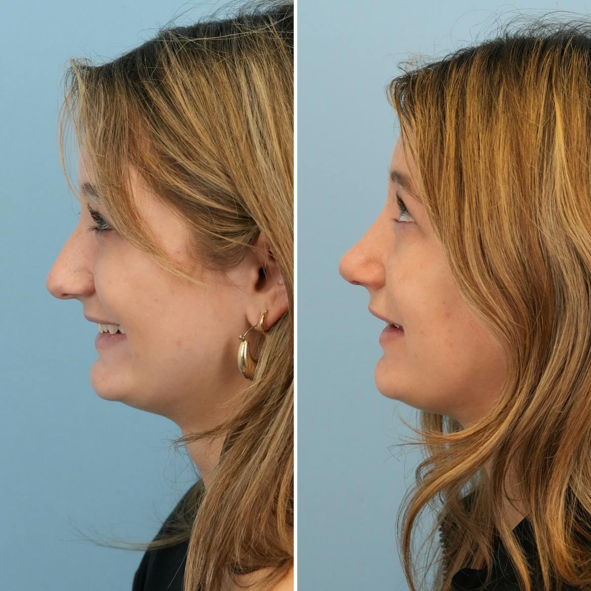 Rhinoplasty Before & After Gallery - Patient 177155 - Image 6
