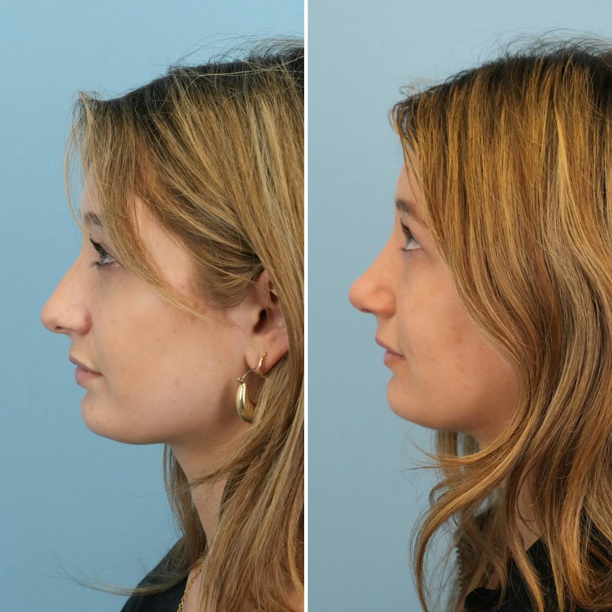 Rhinoplasty Before & After Gallery - Patient 177155 - Image 7