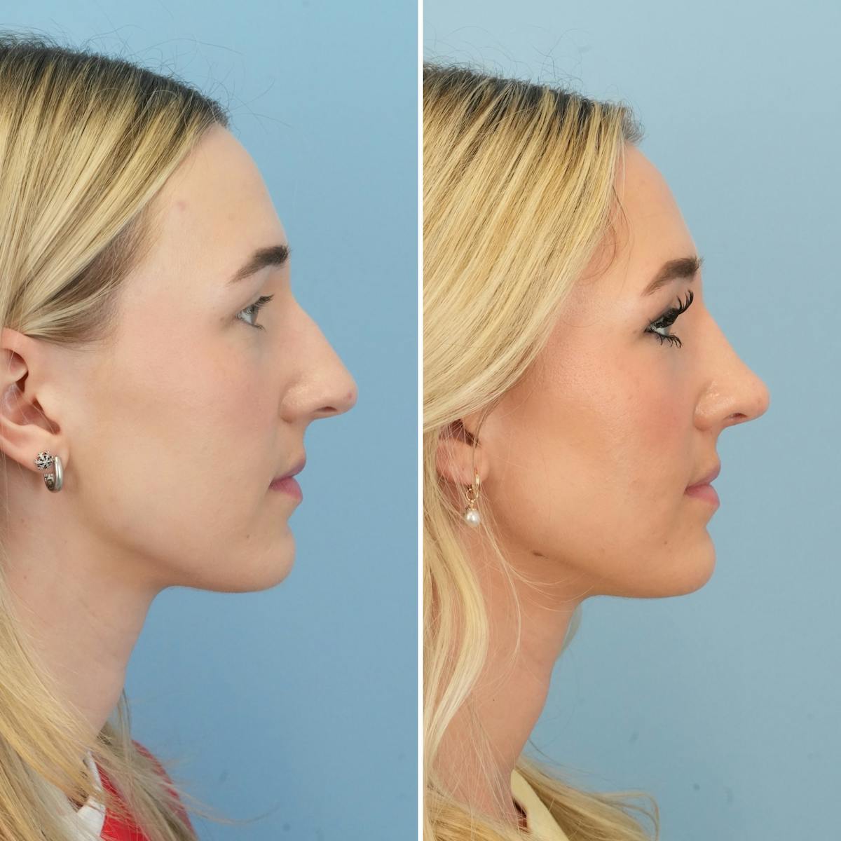 Rhinoplasty Before & After Gallery - Patient 240781 - Image 1