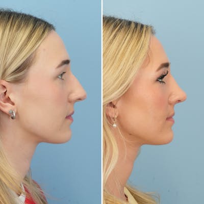 Rhinoplasty Before & After Gallery - Patient 240781 - Image 1