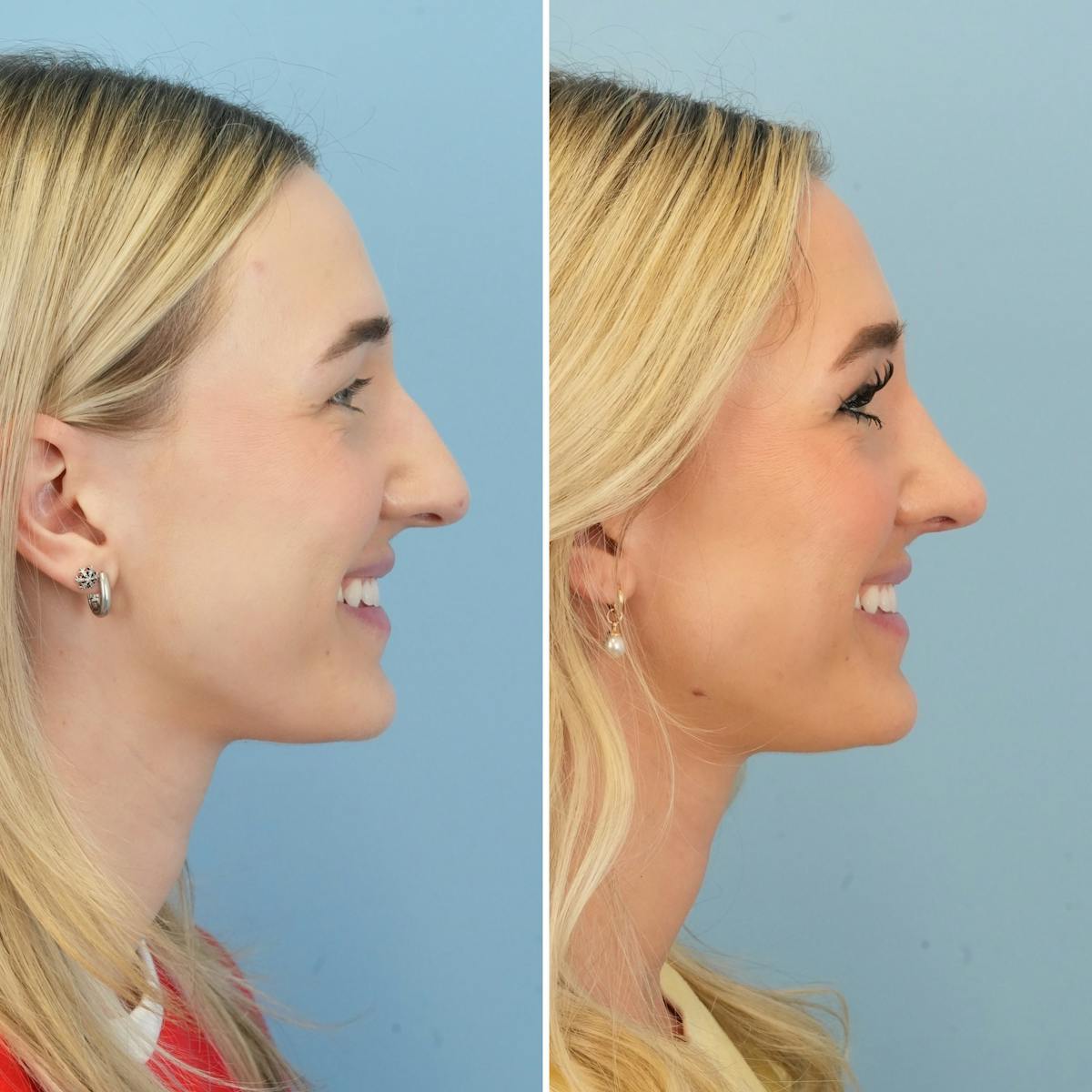 Rhinoplasty Before & After Gallery - Patient 240781 - Image 2
