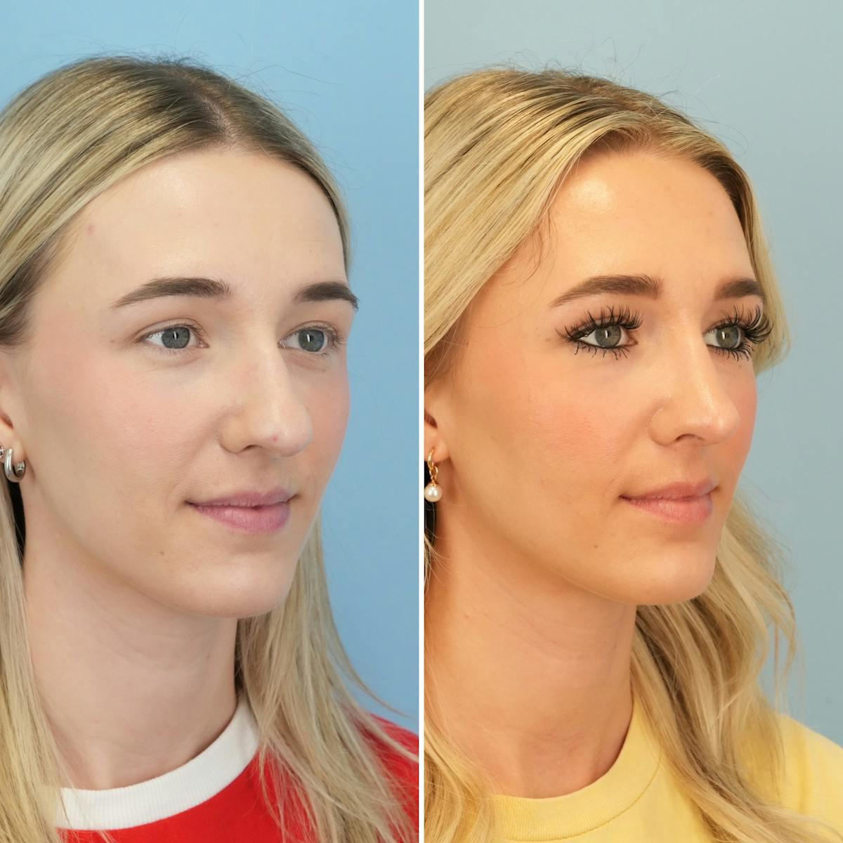 Rhinoplasty Before & After Gallery - Patient 240781 - Image 3