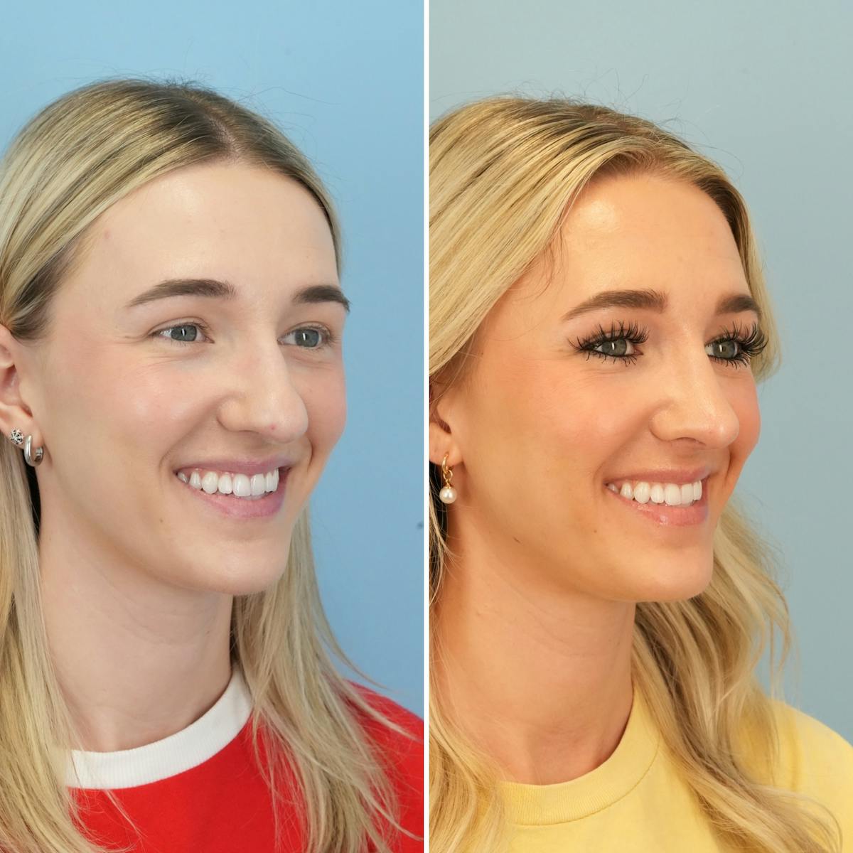 Rhinoplasty Before & After Gallery - Patient 240781 - Image 4