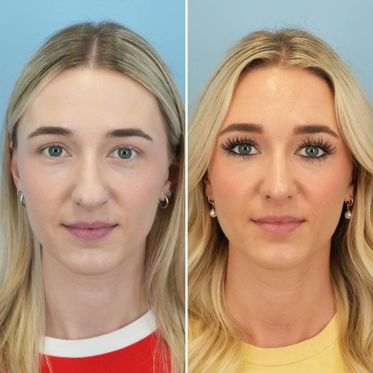 Rhinoplasty Before & After Gallery - Patient 240781 - Image 5