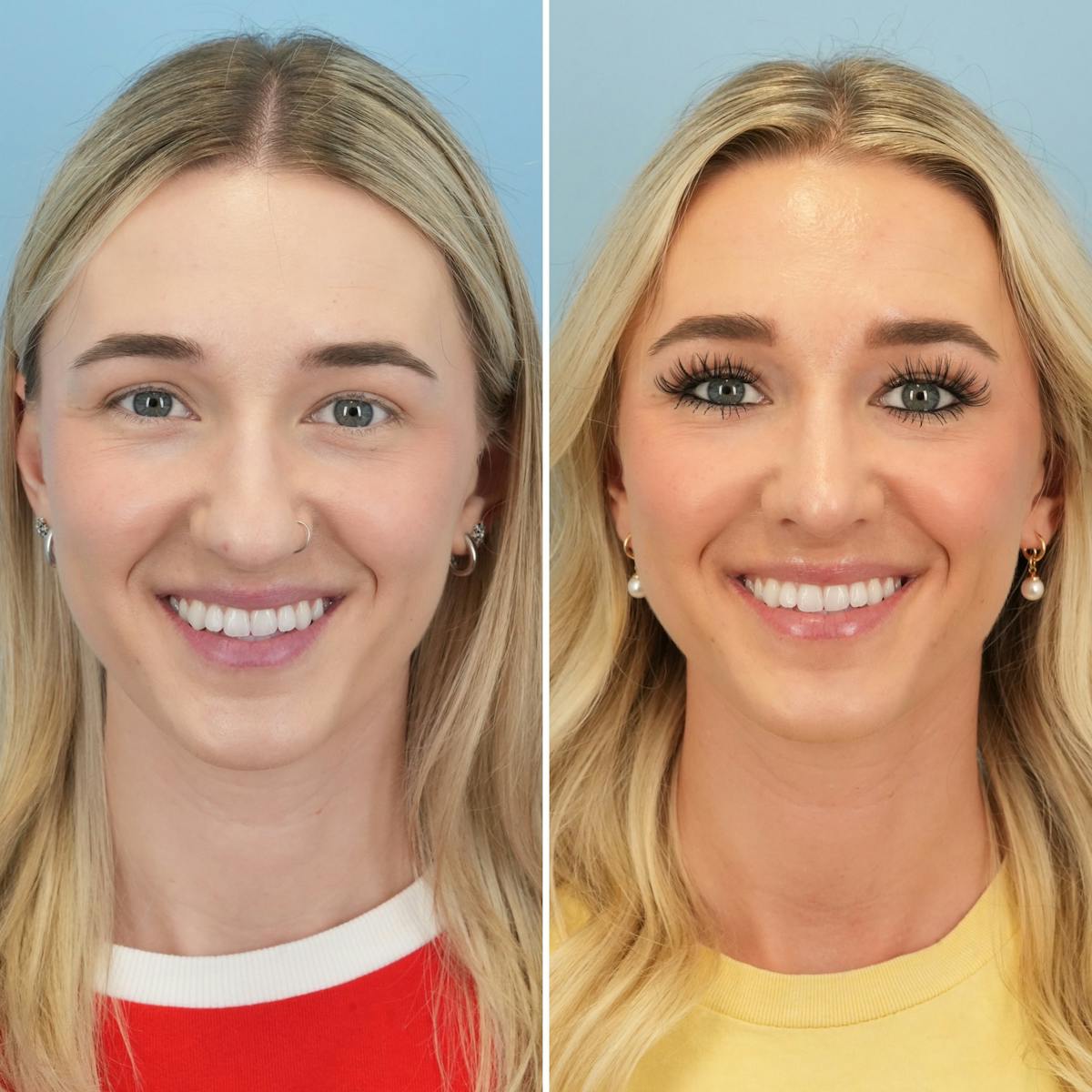 Rhinoplasty Before & After Gallery - Patient 240781 - Image 6