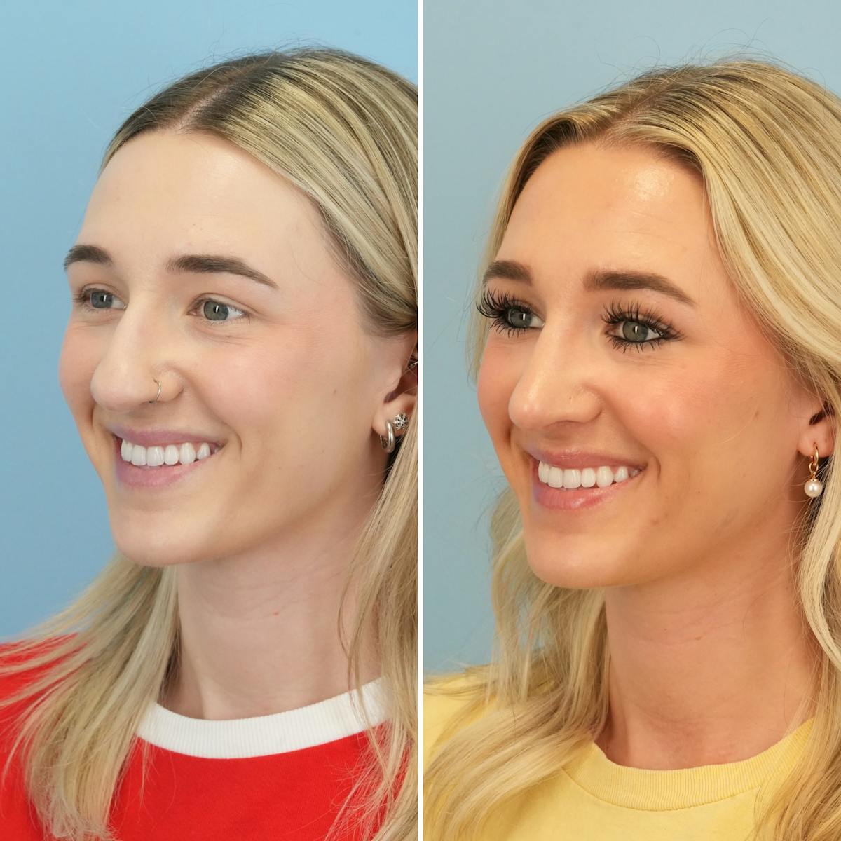 Rhinoplasty Before & After Gallery - Patient 240781 - Image 7