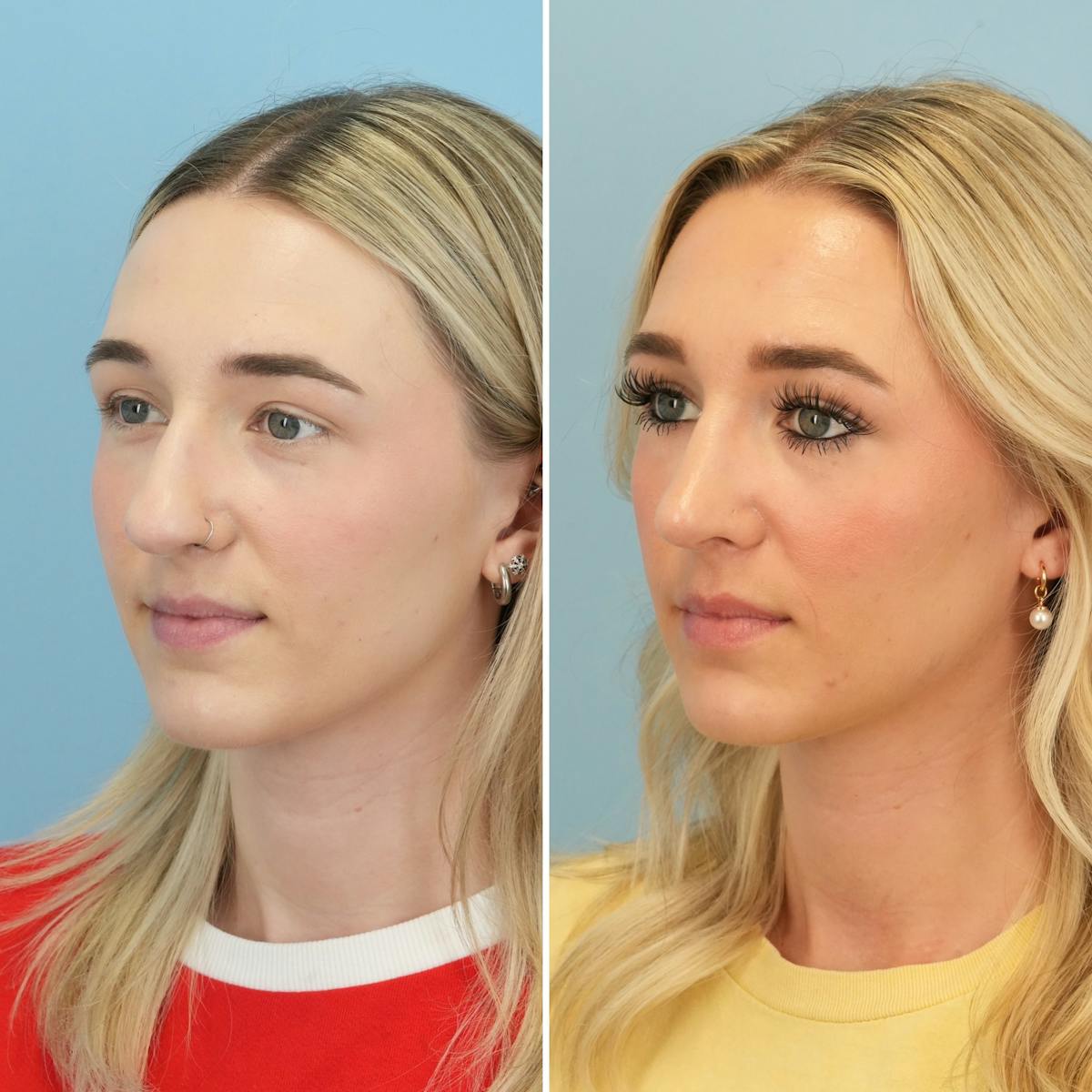 Rhinoplasty Before & After Gallery - Patient 240781 - Image 8