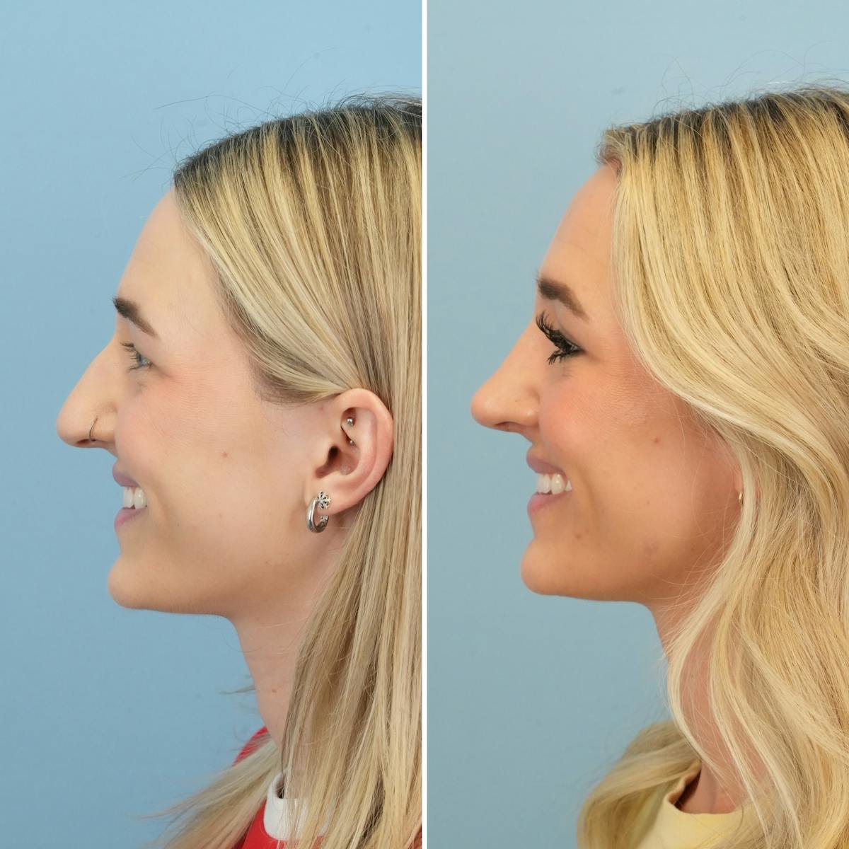 Rhinoplasty Before & After Gallery - Patient 240781 - Image 9