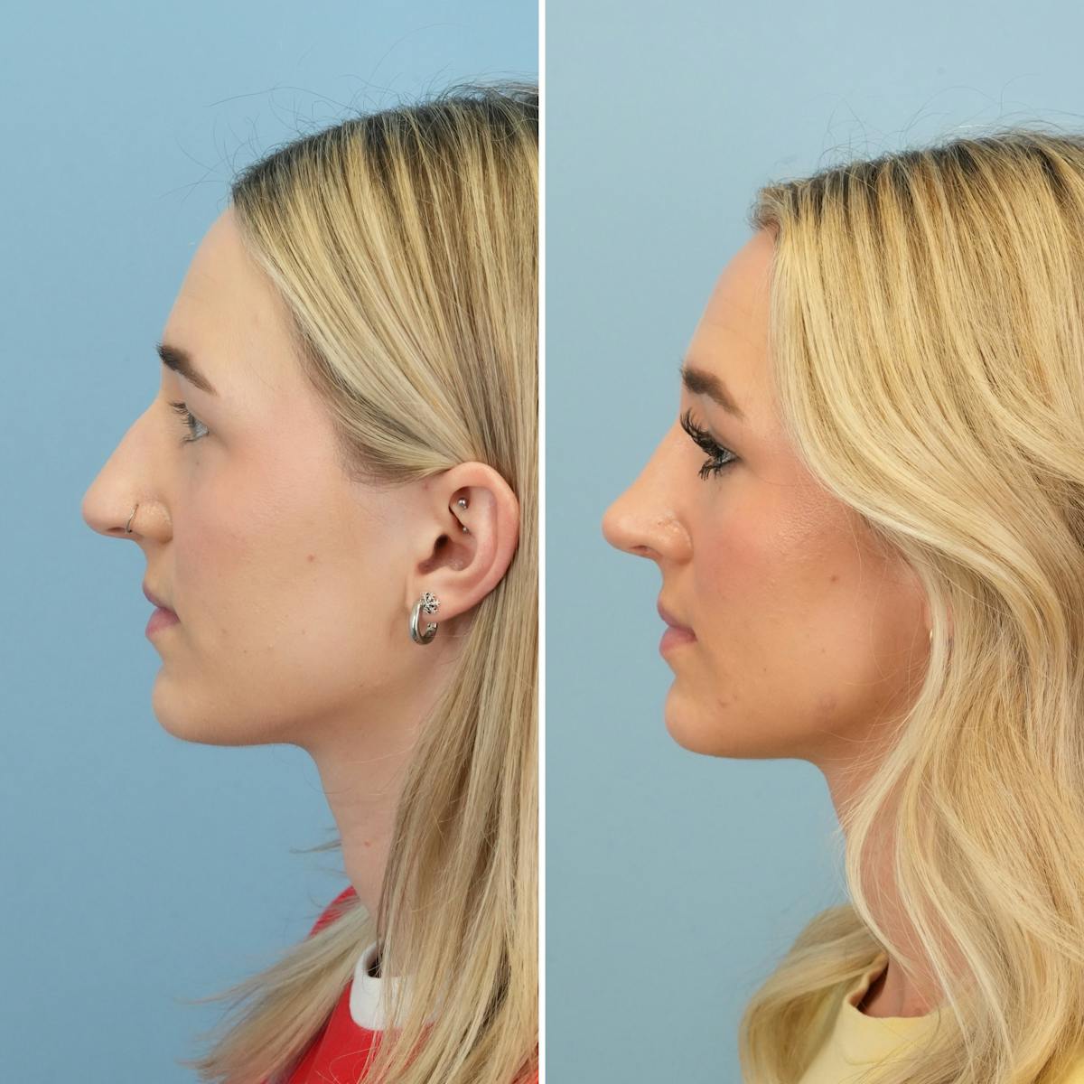 Rhinoplasty Before & After Gallery - Patient 240781 - Image 10