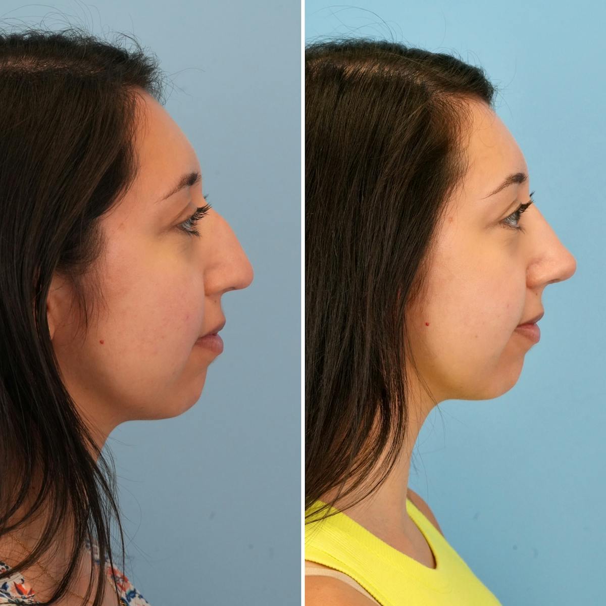 Rhinoplasty Before & After Gallery - Patient 225770 - Image 1