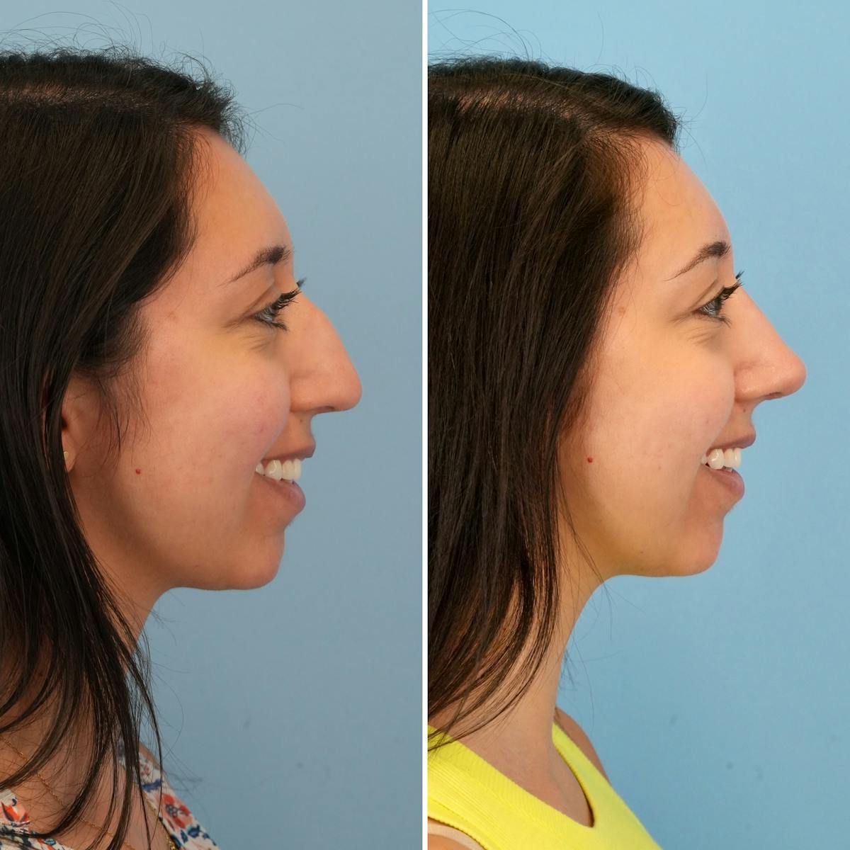 Rhinoplasty Before & After Gallery - Patient 225770 - Image 2