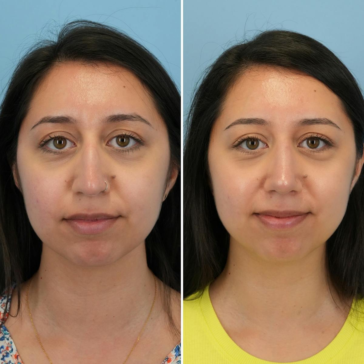 Rhinoplasty Before & After Gallery - Patient 225770 - Image 4