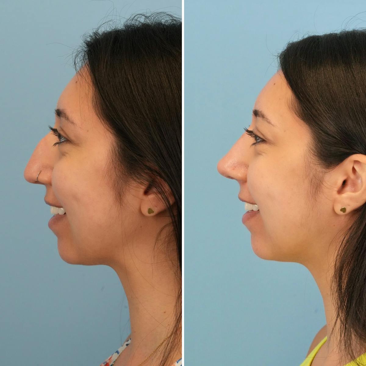 Rhinoplasty Before & After Gallery - Patient 225770 - Image 6