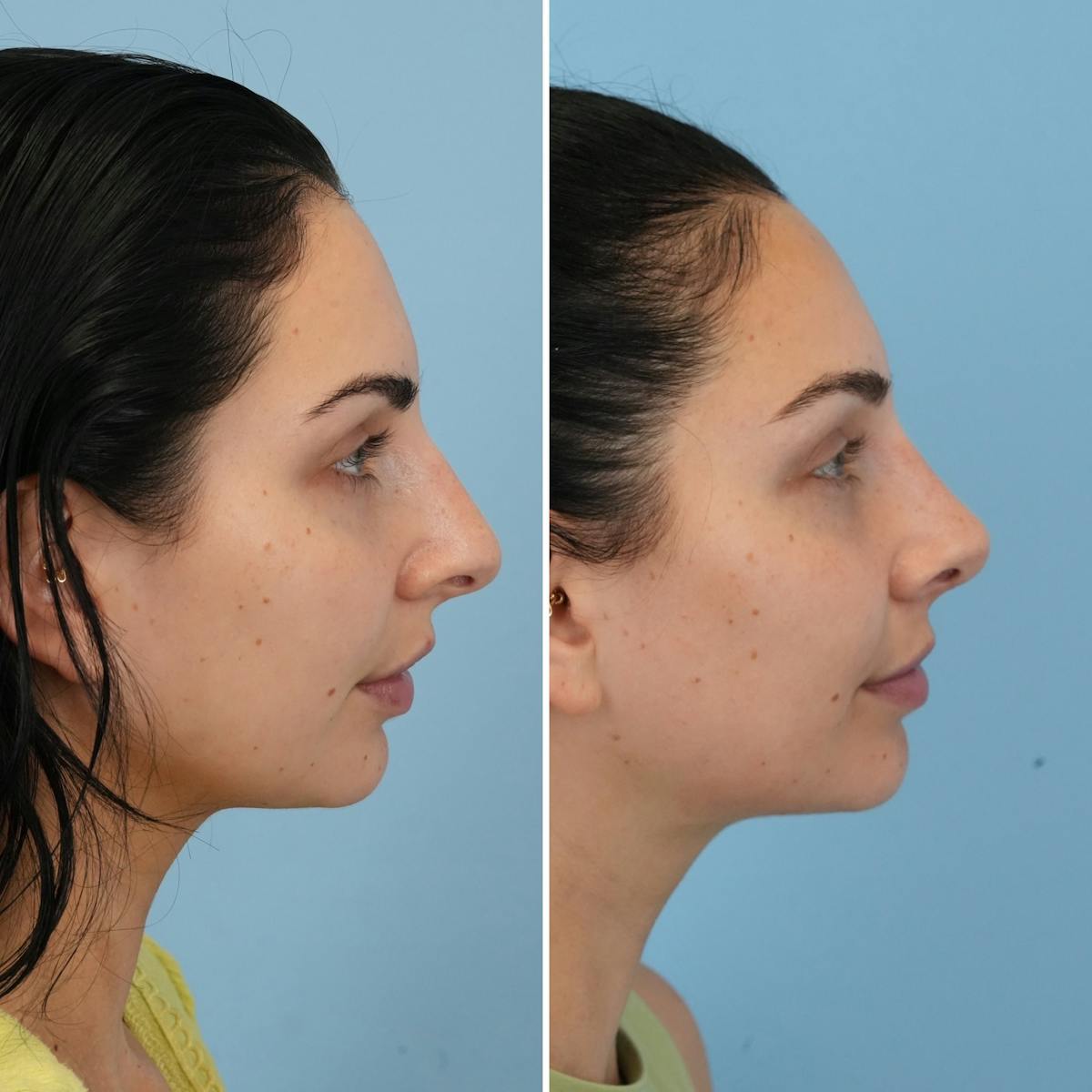 Rhinoplasty Before & After Gallery - Patient 273372 - Image 1
