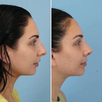 Rhinoplasty Before & After Gallery - Patient 273372 - Image 1