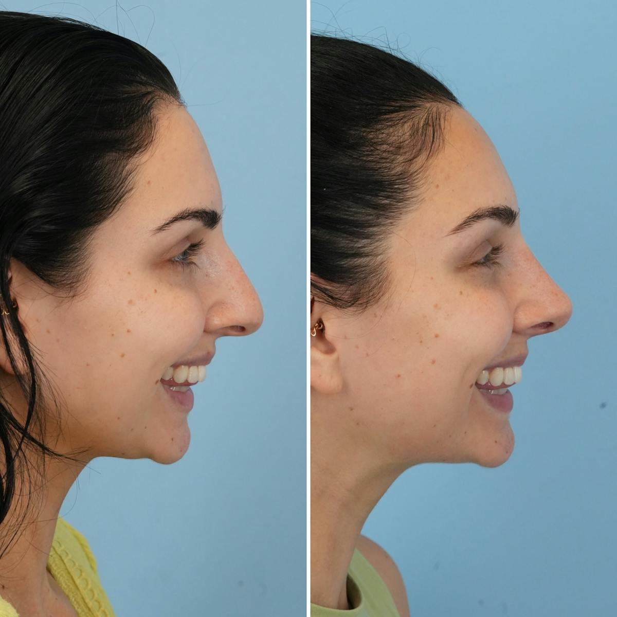 Rhinoplasty Before & After Gallery - Patient 273372 - Image 2