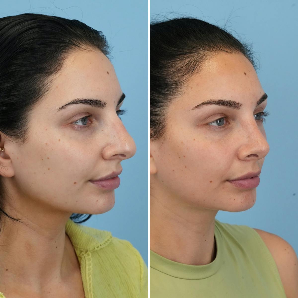 Rhinoplasty Before & After Gallery - Patient 273372 - Image 3