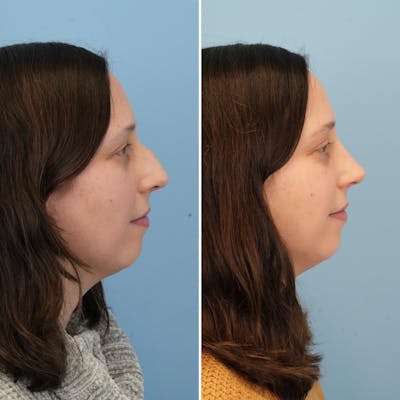 Rhinoplasty Before & After Gallery - Patient 237232 - Image 1
