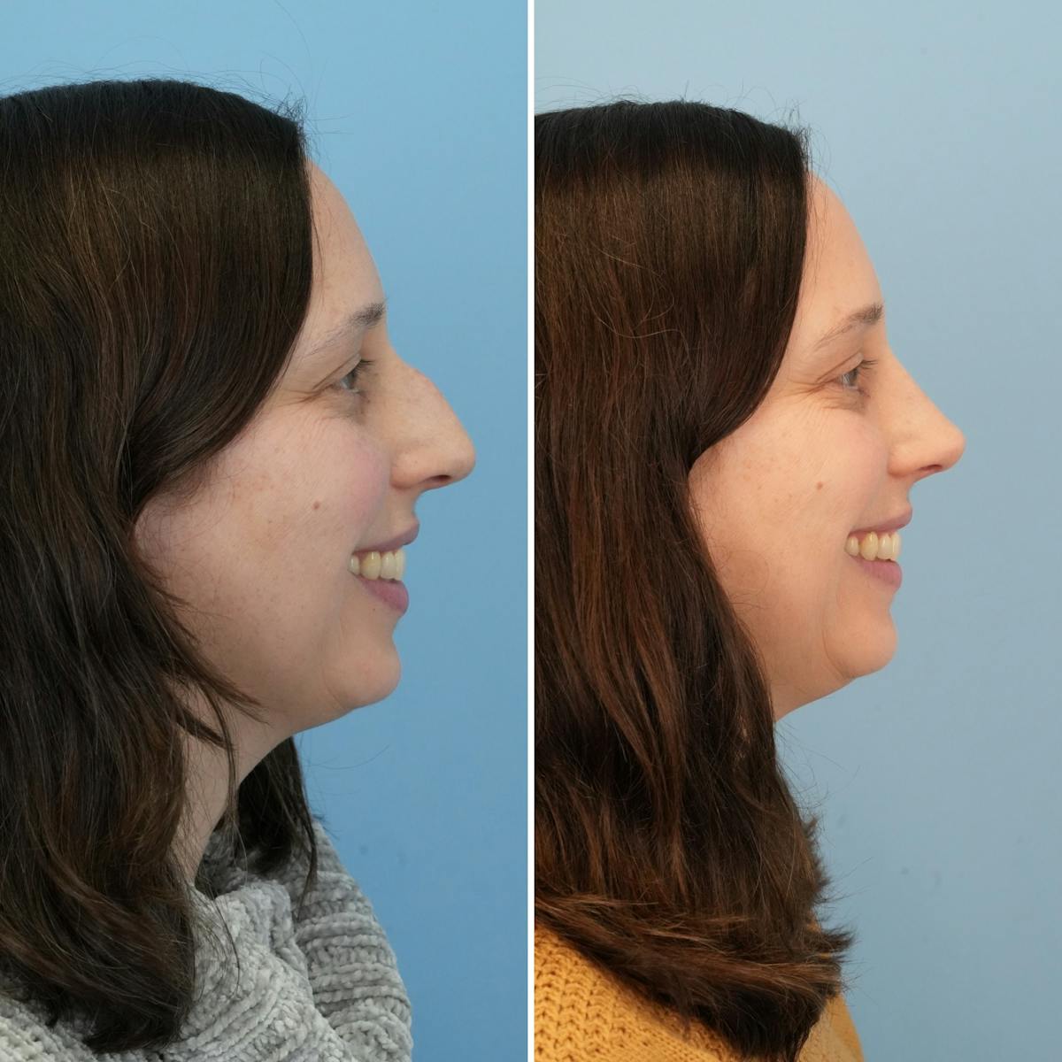 Rhinoplasty Before & After Gallery - Patient 237232 - Image 2